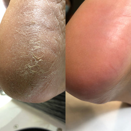 NAILSOFTHEDAY Podiatry Keratolytic for feet