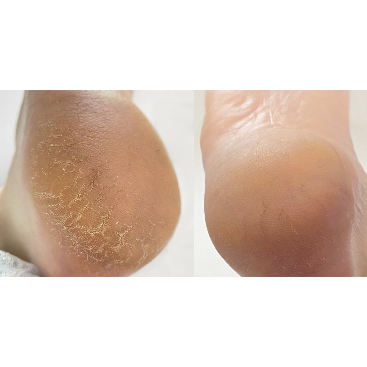 NAILSOFTHEDAY Podology Crema contra grietas