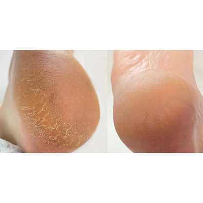 NAILSOFTHEDAY Podiatry Cracked Crack Cream